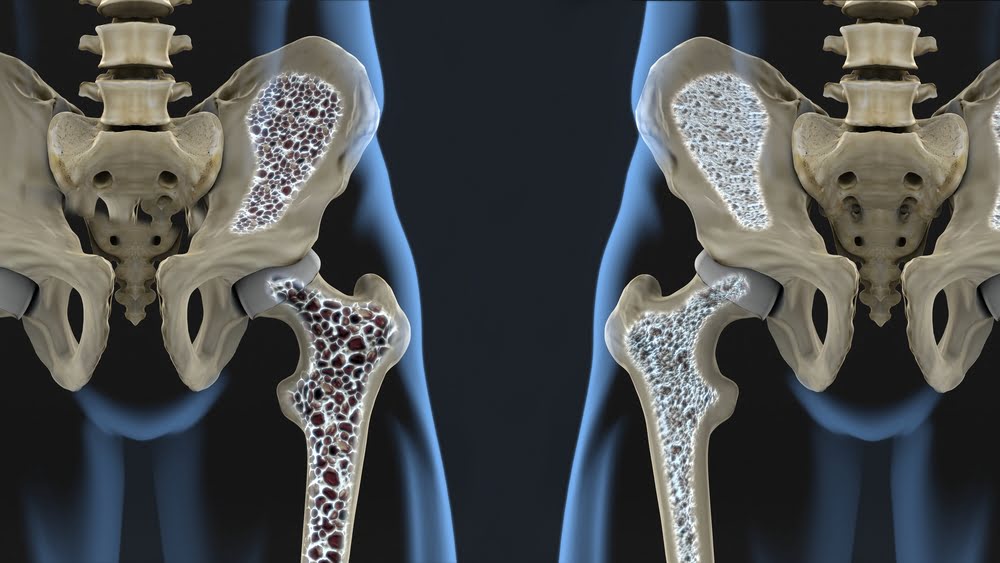 Osteopenia eshte totalisht e kunderta e osteoporozes.