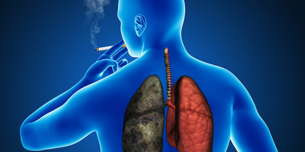 Pirja e duhanit eshte nje nga fakoret e rreziku pneumonial.