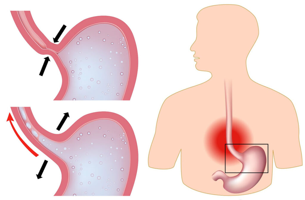 Semundja e refluksit gastroezofageal