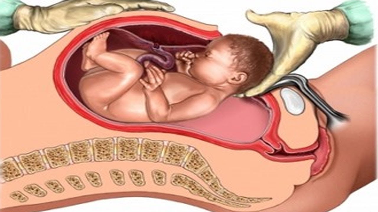 Cesarean section, everything you need to know: Medicine