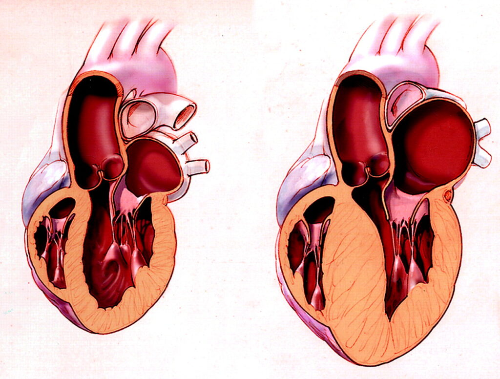 Kardiomiopatia