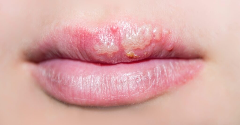 Herpes oral