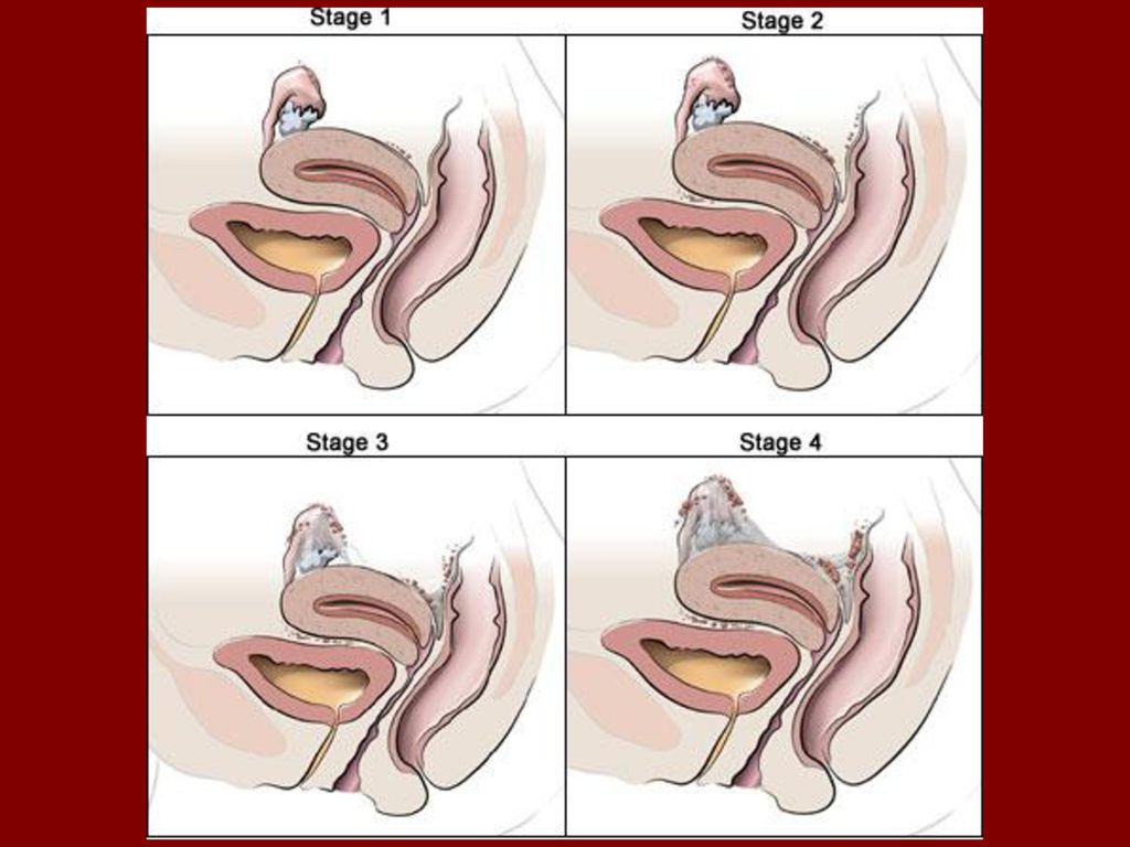 Endometrioza dhe fazat e saj