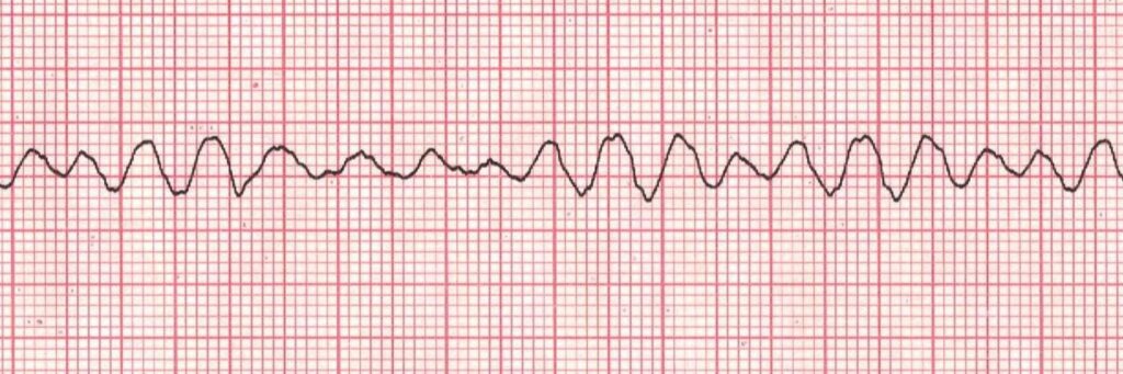 Fibrilacioni ventrikular qe ben ndryshimin e ritmit te zemres ne menyre dramatike te arresti kardiak.