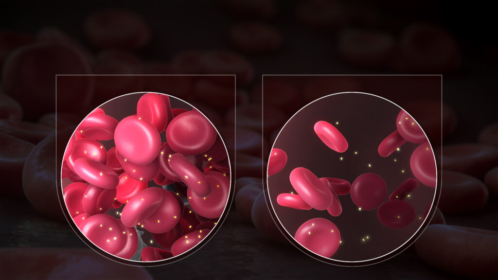 Qelizat e kuqe te gjakut rrallohen nga anemia e shkaktuar nga mungesa e hekurit.