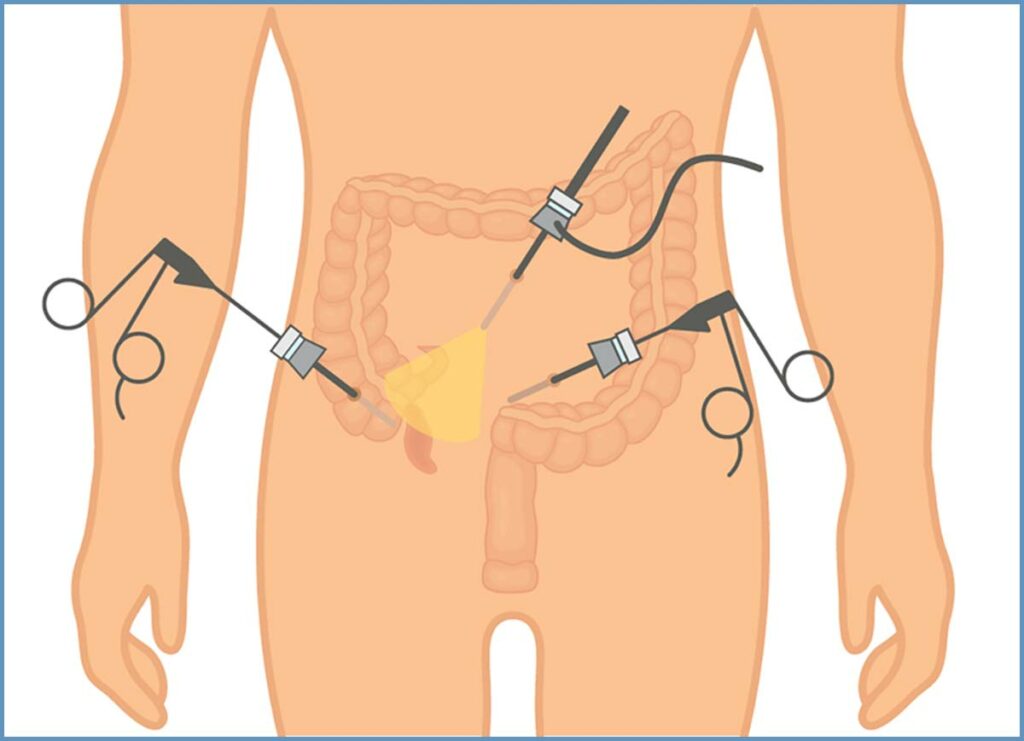 Apendektomi laparoskopike