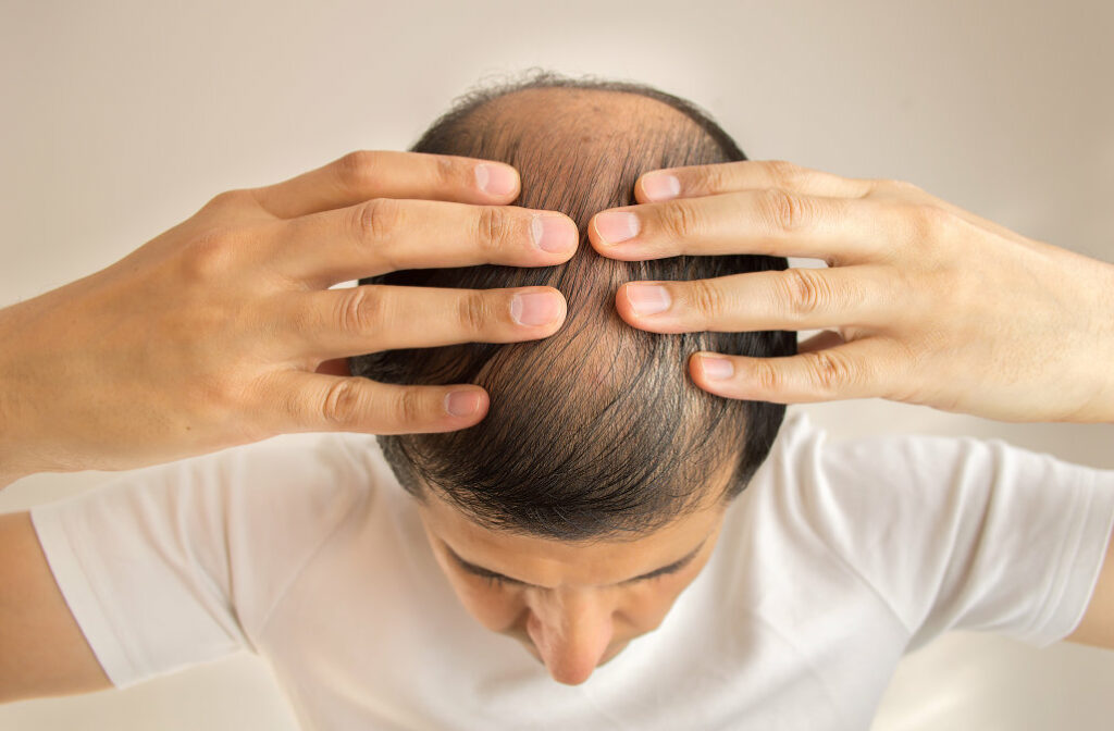 Alopecia shqip nis me rrallimin gradual te flokeve ne maje te kokes.