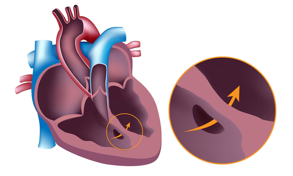 Semundje e lindur e zemres e cila rrit rrezikun nga arresti kardiak.