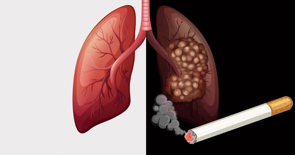 Duhanpirja aktive dhe pasive shkaktojne kancer.