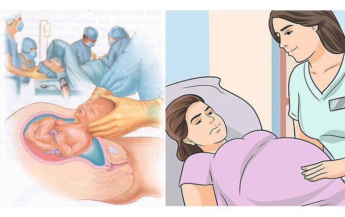 Sezaryen sonrası vajinal doğum (VBAC): Tıp