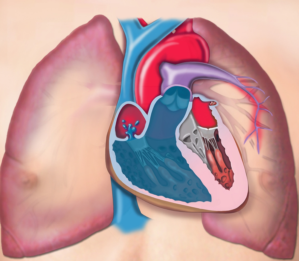 Hipertensioni pulmonar nje nga semundjet e mushkerive